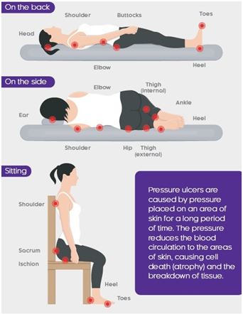 areas at risk of pressure damage
